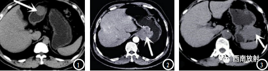 胃肠道间质瘤-1