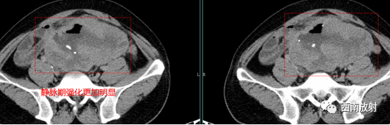 胃肠道间质瘤-3
