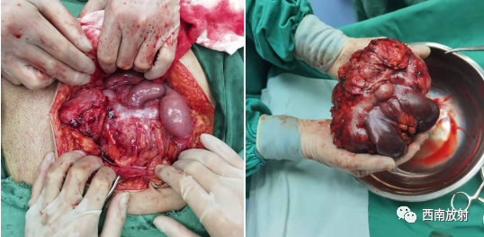 胃肠道间质瘤-4