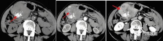胃肠道间质瘤-6