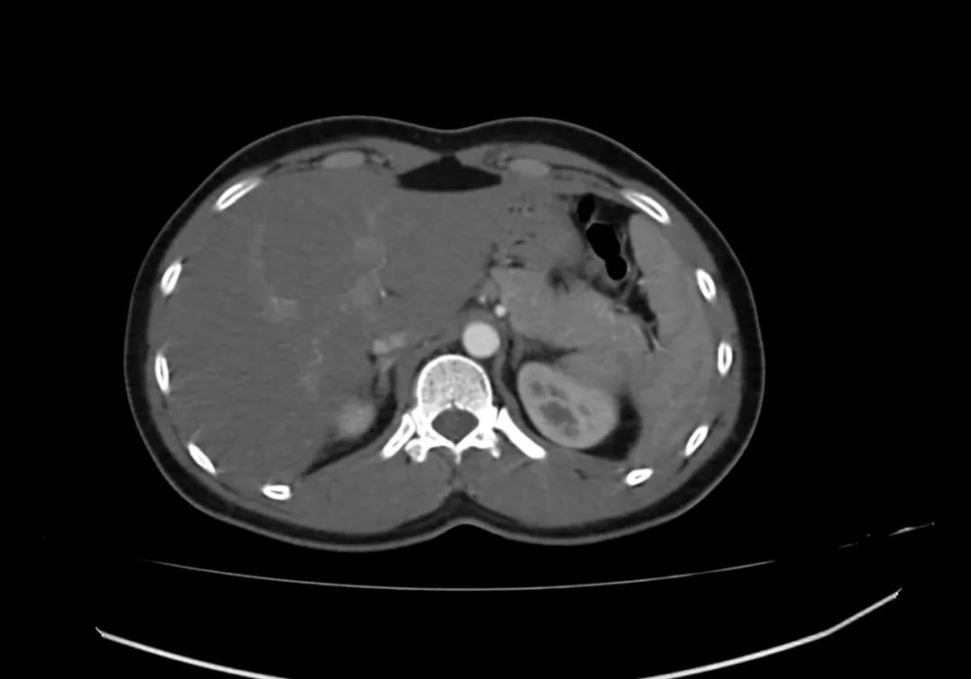 【病例】完全性环状胰腺1例CT影像-1