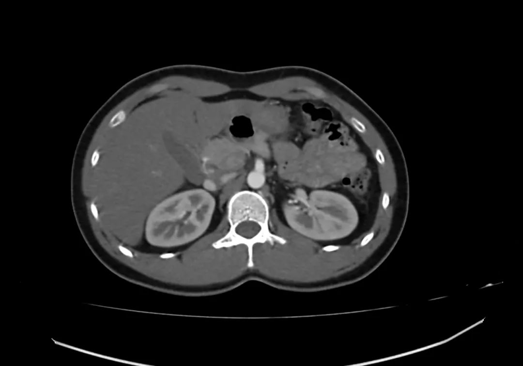 【病例】完全性环状胰腺1例CT影像-3
