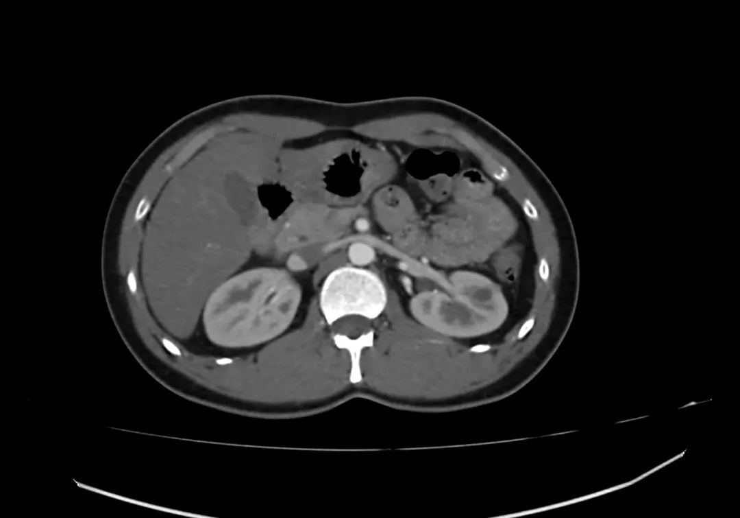 【病例】完全性环状胰腺1例CT影像-4
