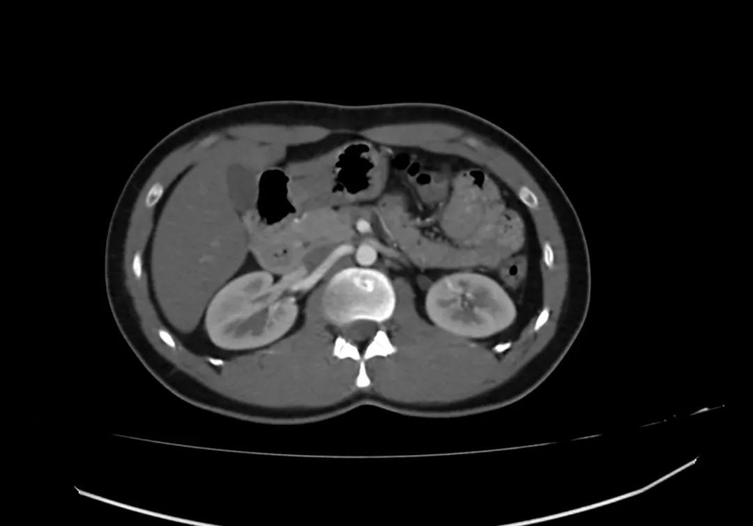 【病例】完全性环状胰腺1例CT影像-5