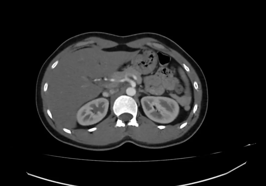 【病例】完全性环状胰腺1例CT影像-2