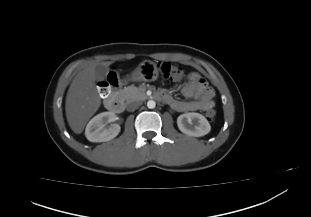【病例】完全性环状胰腺1例CT影像-6