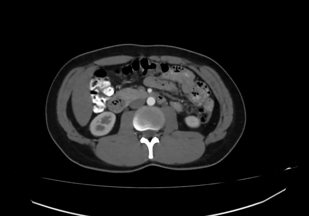 【病例】完全性环状胰腺1例CT影像-8