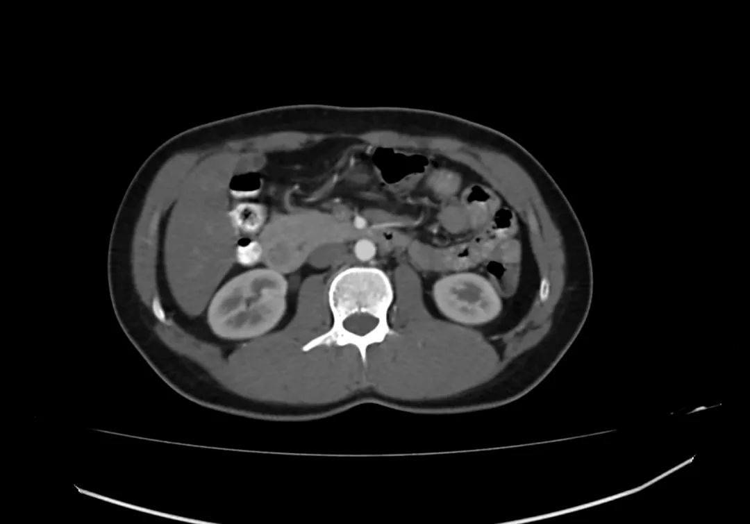 【病例】完全性环状胰腺1例CT影像-7
