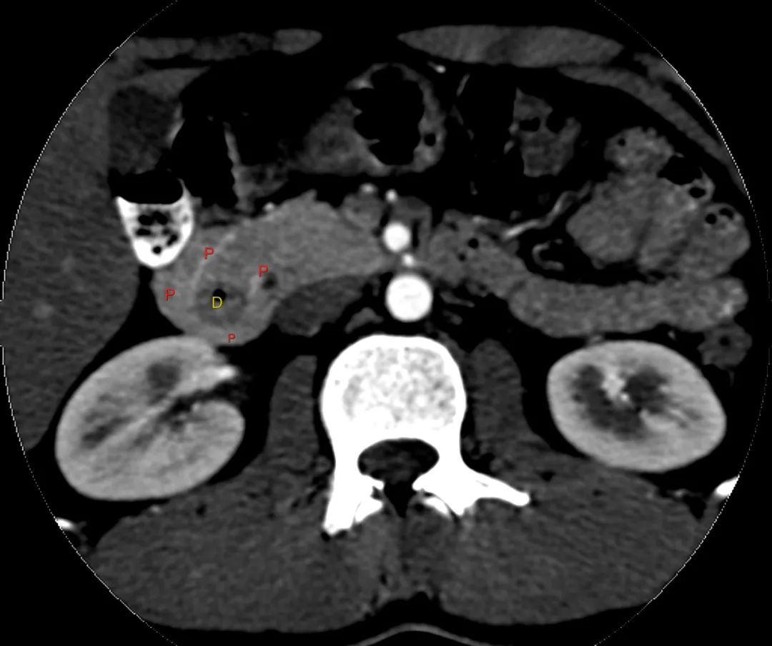 【病例】完全性环状胰腺1例CT影像-10