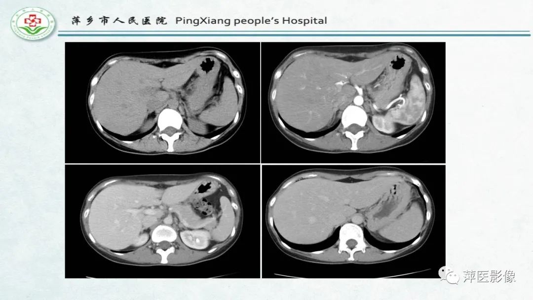 【PPT】HCC影像诊断思路-8