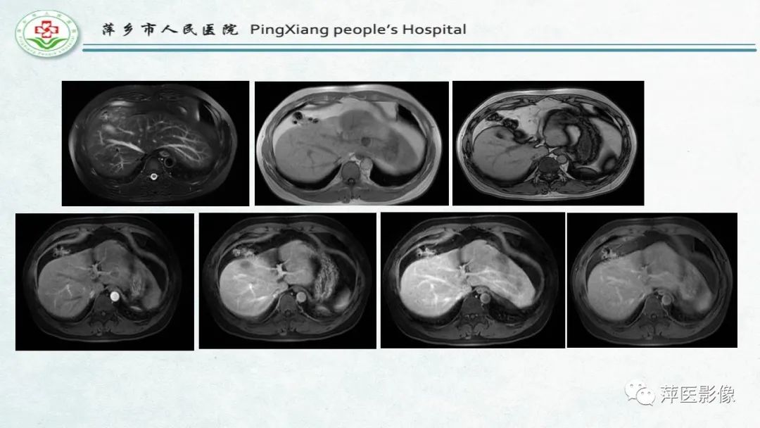 【PPT】HCC影像诊断思路-11