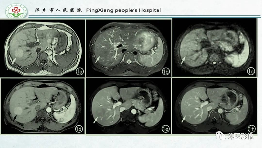 【PPT】HCC影像诊断思路-21