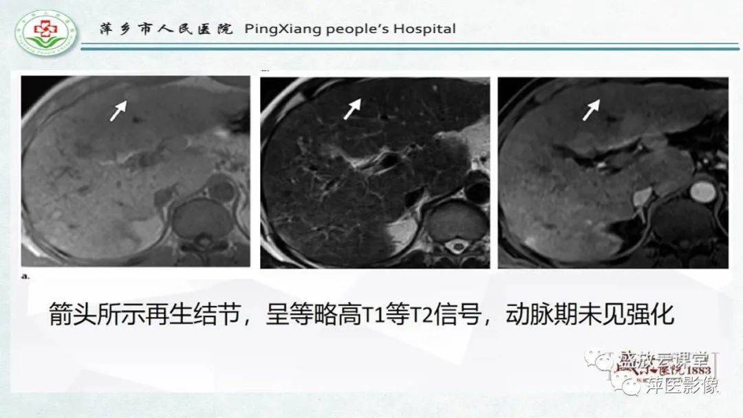 【PPT】HCC影像诊断思路-22
