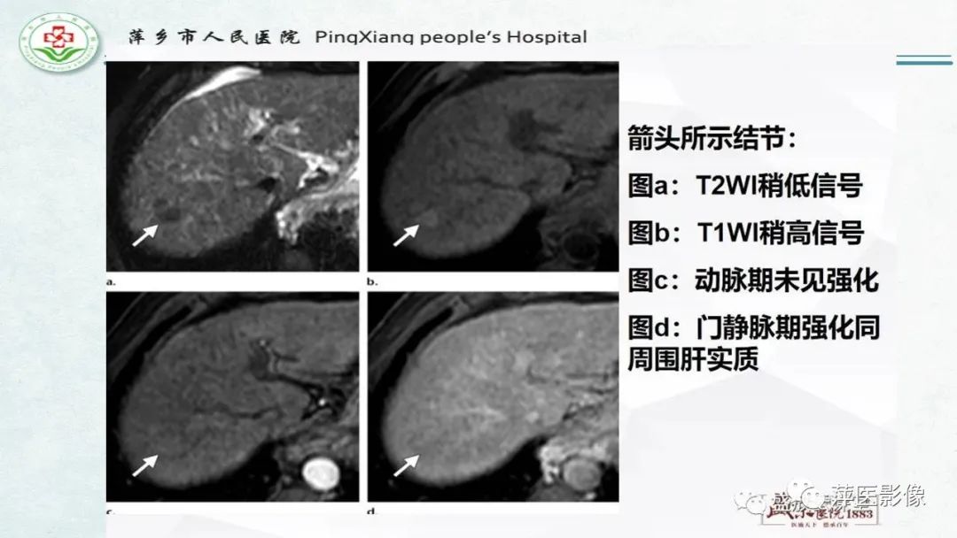 【PPT】HCC影像诊断思路-27