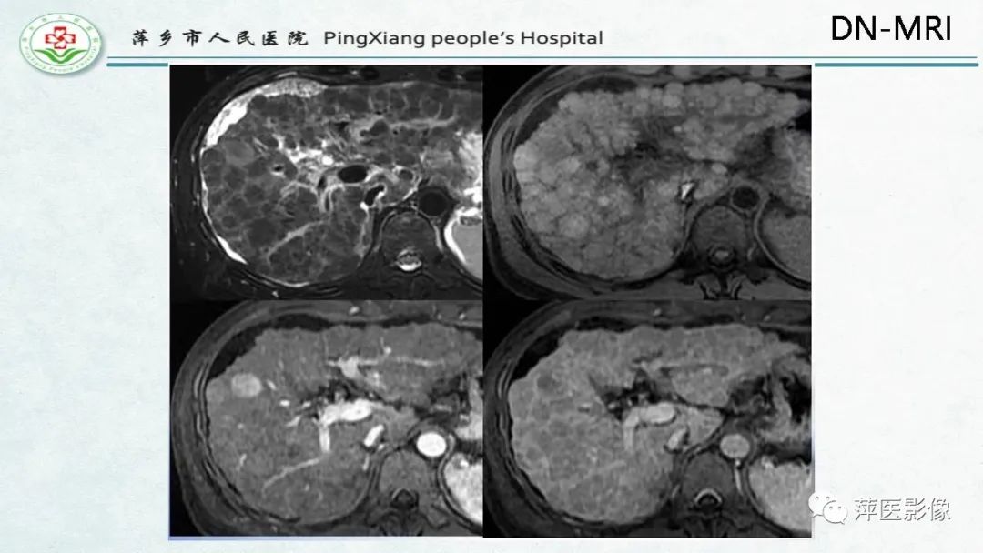 【PPT】HCC影像诊断思路-29