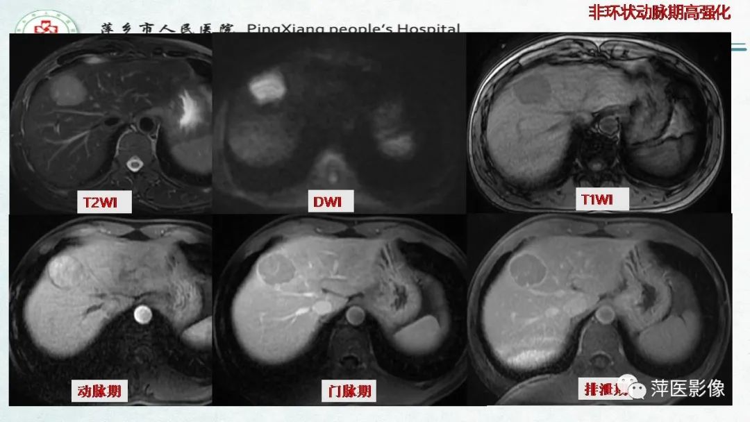 【PPT】HCC影像诊断思路-34