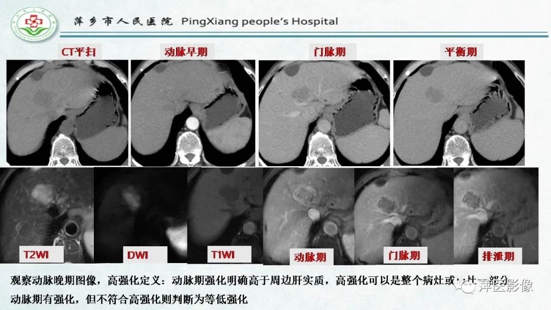 【PPT】HCC影像诊断思路-35