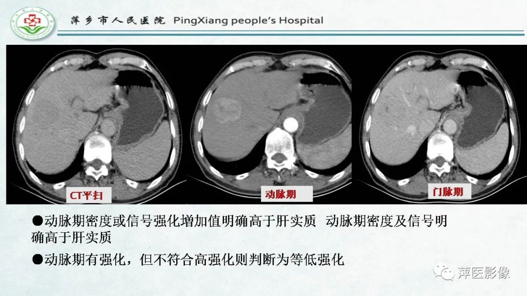 【PPT】HCC影像诊断思路-37