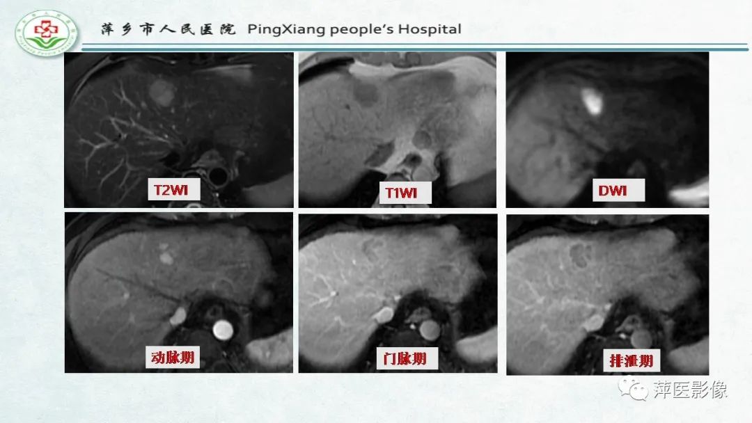 【PPT】HCC影像诊断思路-40