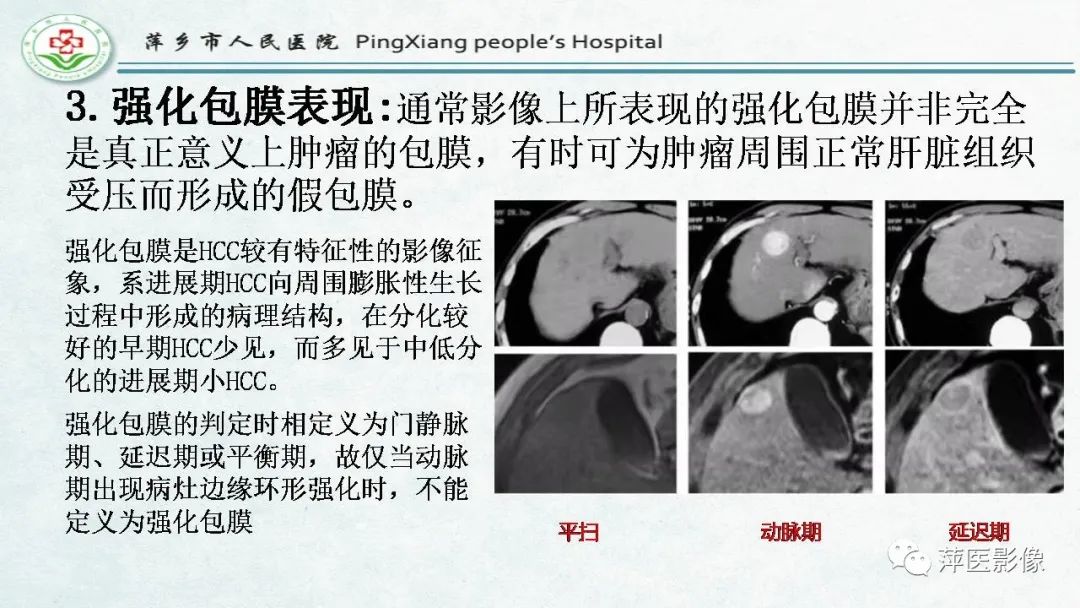 【PPT】HCC影像诊断思路-41