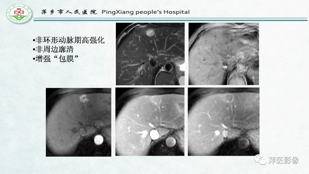 【PPT】HCC影像诊断思路-42