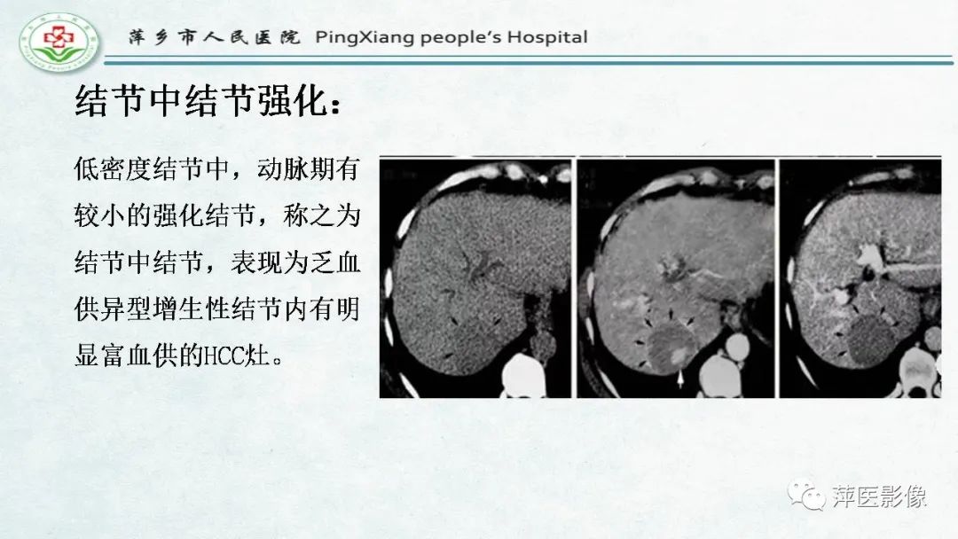 【PPT】HCC影像诊断思路-48