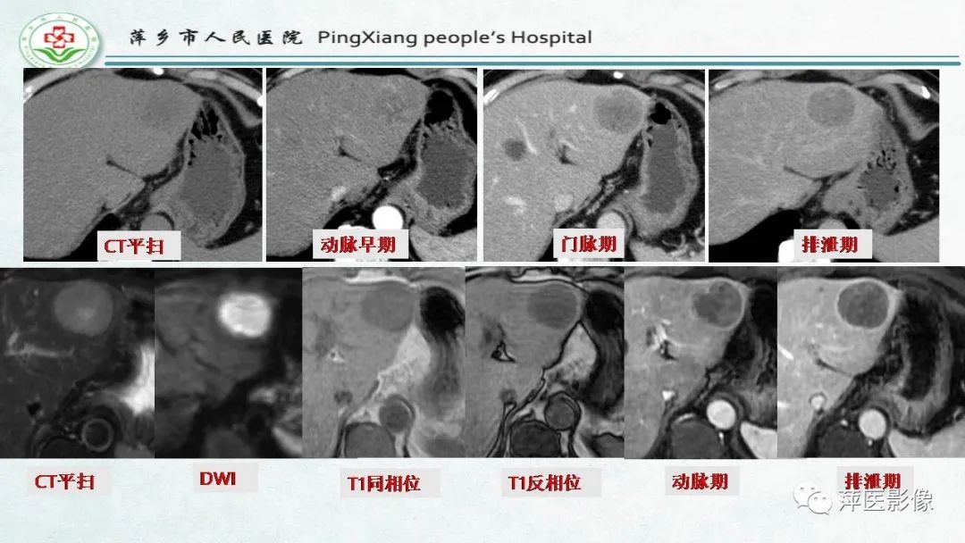 【PPT】HCC影像诊断思路-51