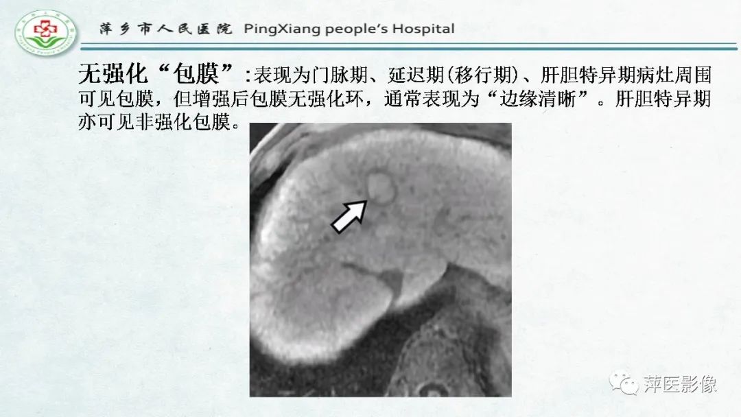 【PPT】HCC影像诊断思路-52