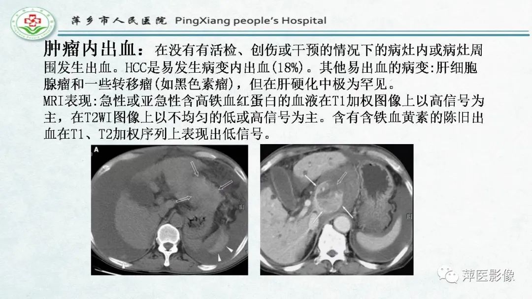 【PPT】HCC影像诊断思路-53