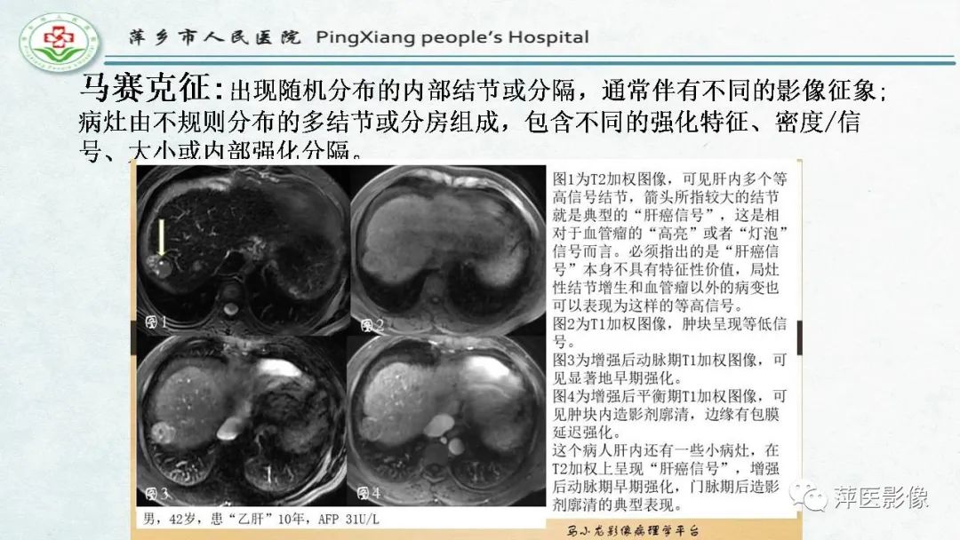 【PPT】HCC影像诊断思路-55