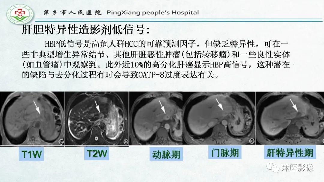 【PPT】HCC影像诊断思路-58