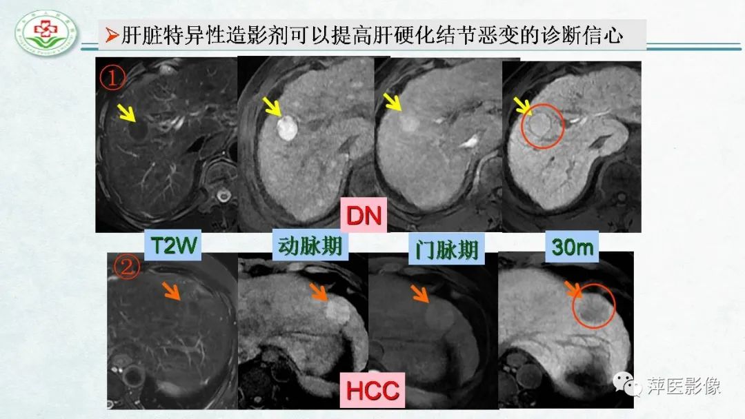 【PPT】HCC影像诊断思路-59