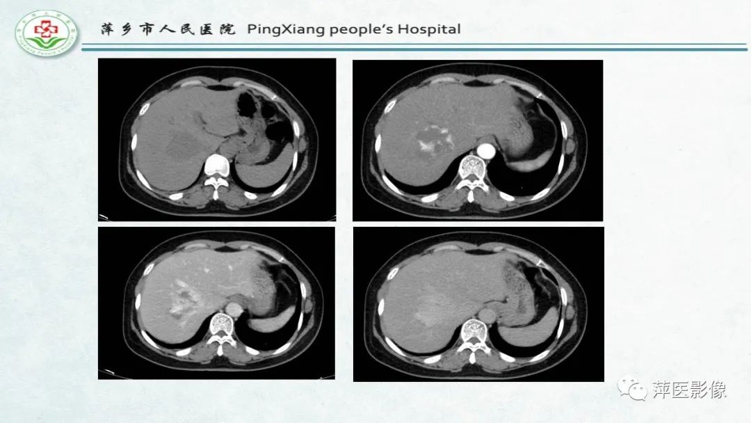 【PPT】HCC影像诊断思路-64