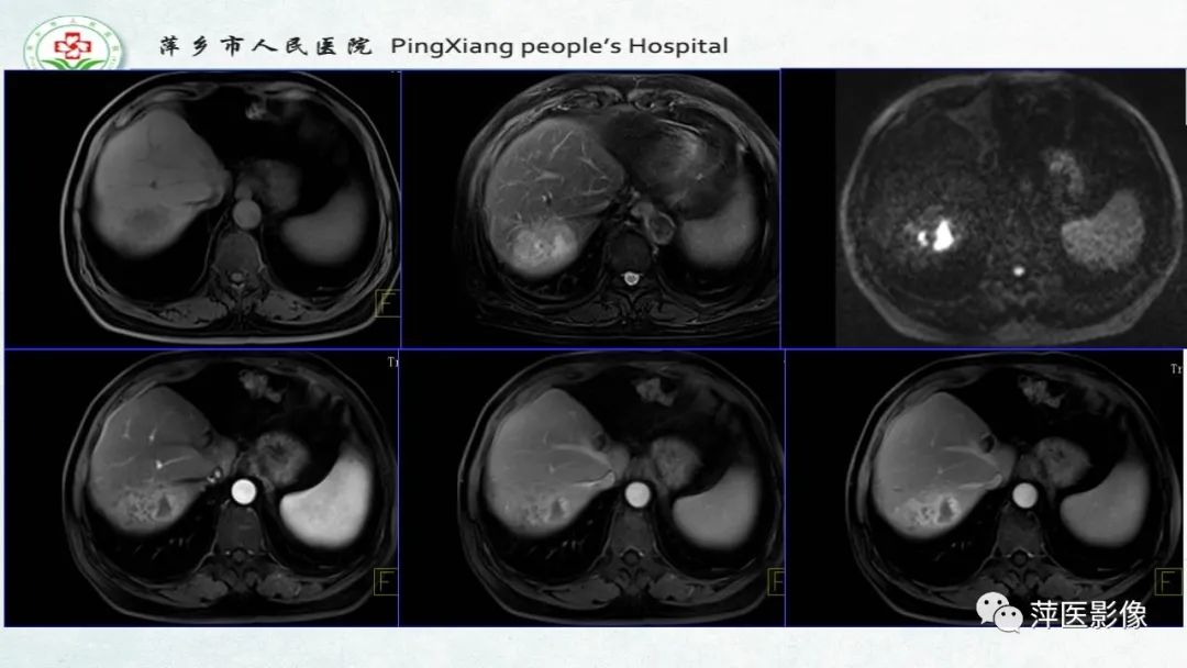 【PPT】HCC影像诊断思路-71