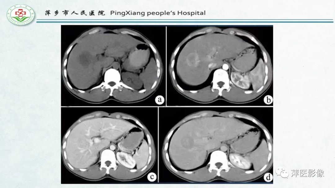 【PPT】HCC影像诊断思路-73