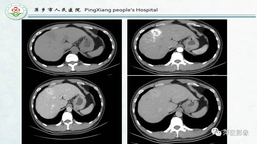 【PPT】HCC影像诊断思路-76