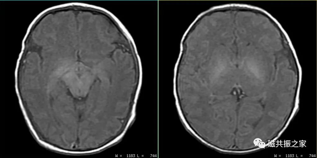 婴幼儿MRI该如何扫描-3
