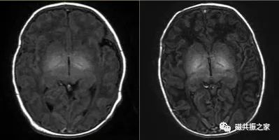 婴幼儿MRI该如何扫描-4