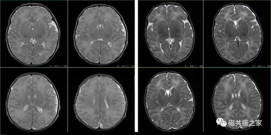 婴幼儿MRI该如何扫描-5