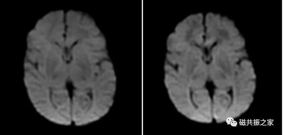 婴幼儿MRI该如何扫描-6
