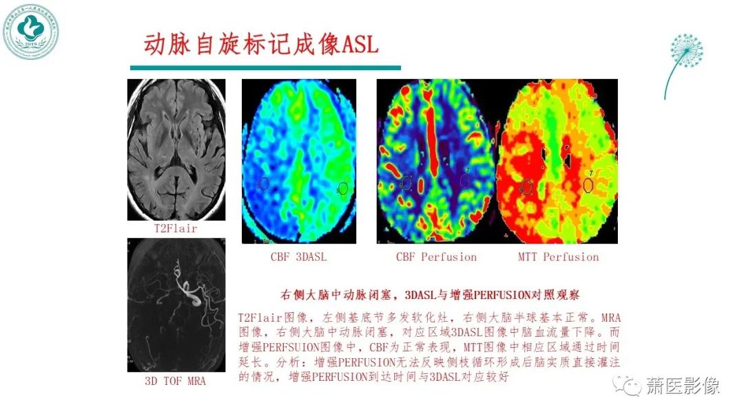【PPT】脑灌注成像原理及在临床中的应用-10