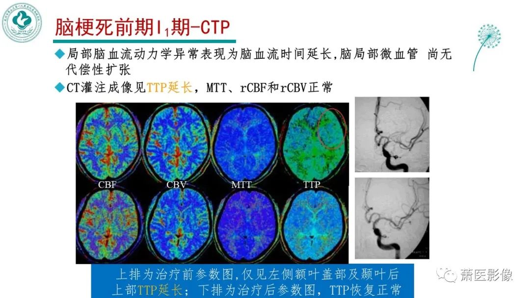 【PPT】脑灌注成像原理及在临床中的应用-16