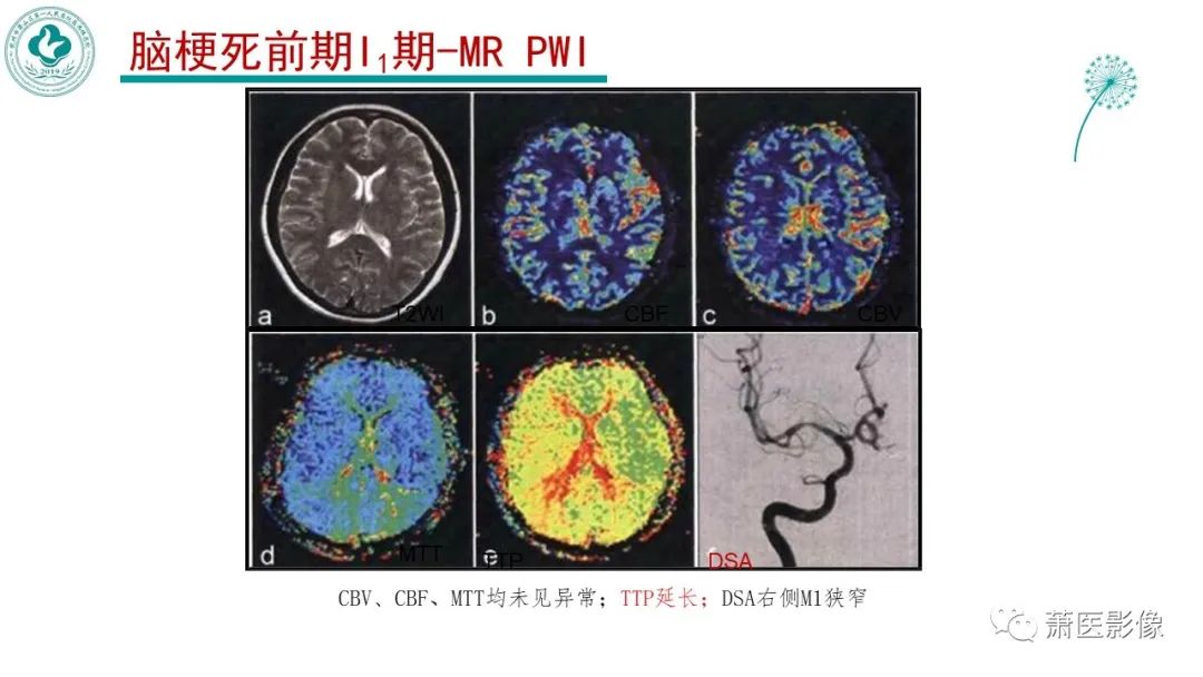 【PPT】脑灌注成像原理及在临床中的应用-17