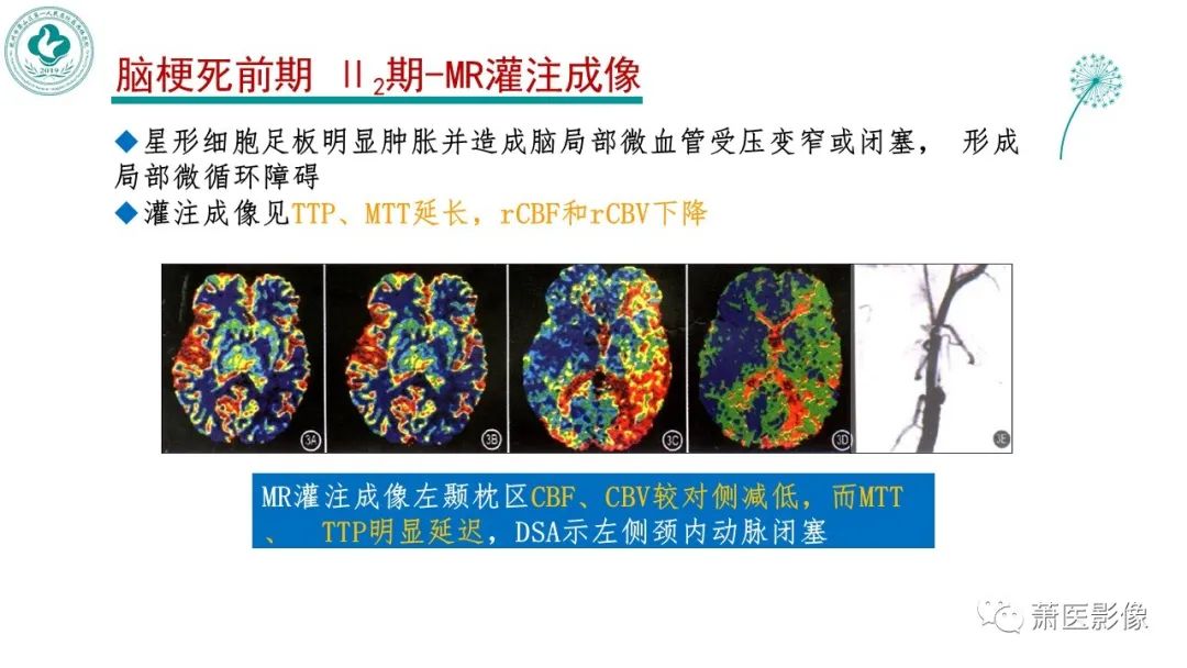 【PPT】脑灌注成像原理及在临床中的应用-20
