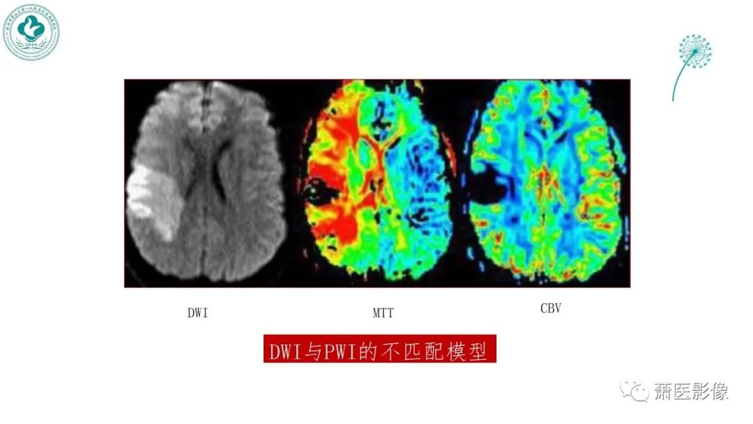 【PPT】脑灌注成像原理及在临床中的应用-26