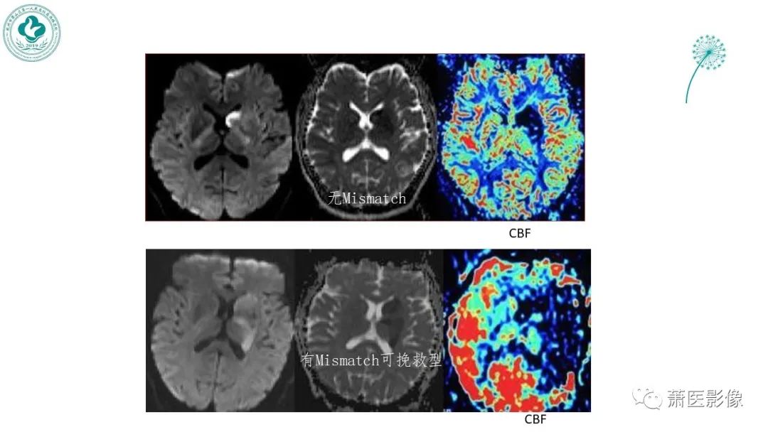 【PPT】脑灌注成像原理及在临床中的应用-27