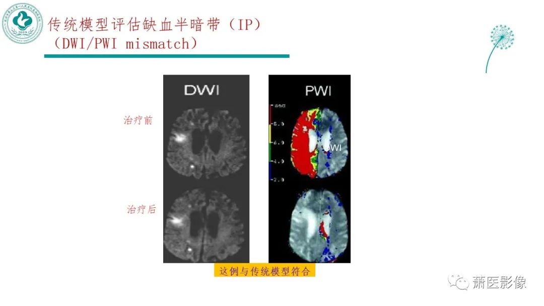 【PPT】脑灌注成像原理及在临床中的应用-28