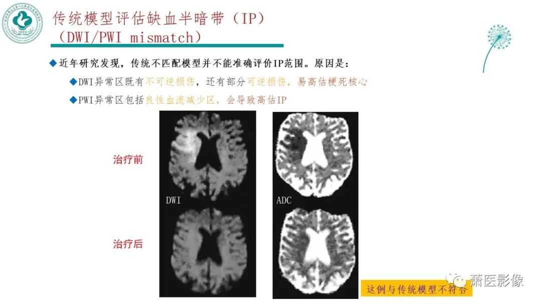 【PPT】脑灌注成像原理及在临床中的应用-29