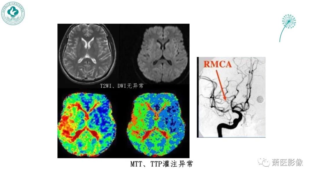 【PPT】脑灌注成像原理及在临床中的应用-32