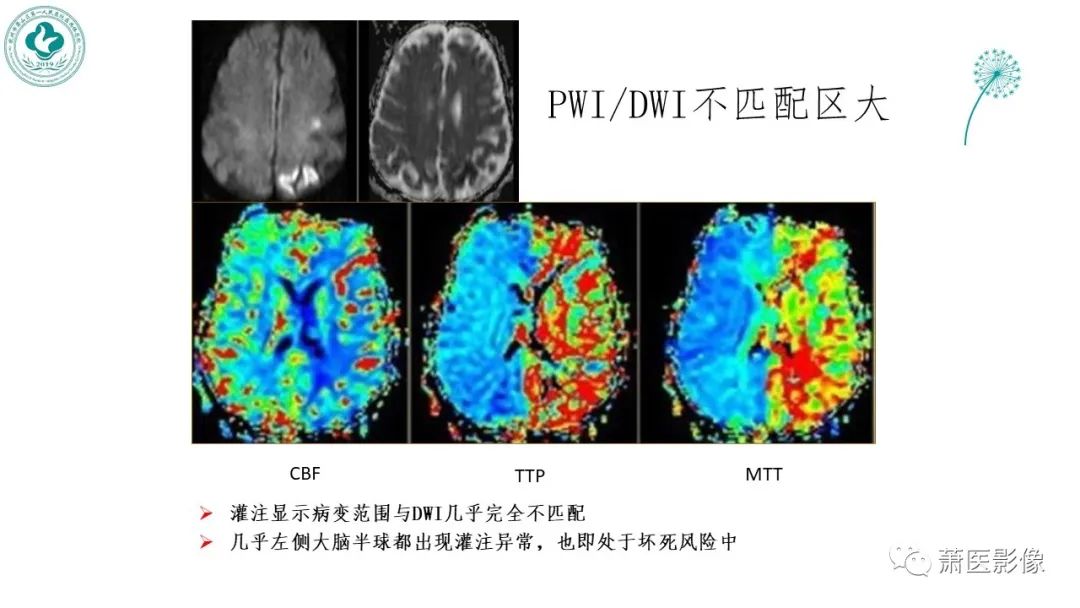 【PPT】脑灌注成像原理及在临床中的应用-33